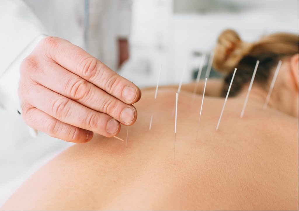 Dry needling with electrical stimulation side effects